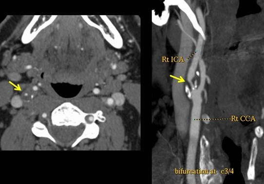 Angio-CT ou Angio-IRM des vaisseaux du cou