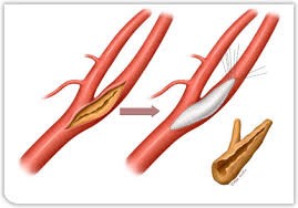 chirurgie ouverte cou heparine