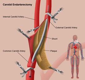 chirurgie ouverte cou - dérivation