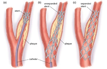 traitement endovasculaire