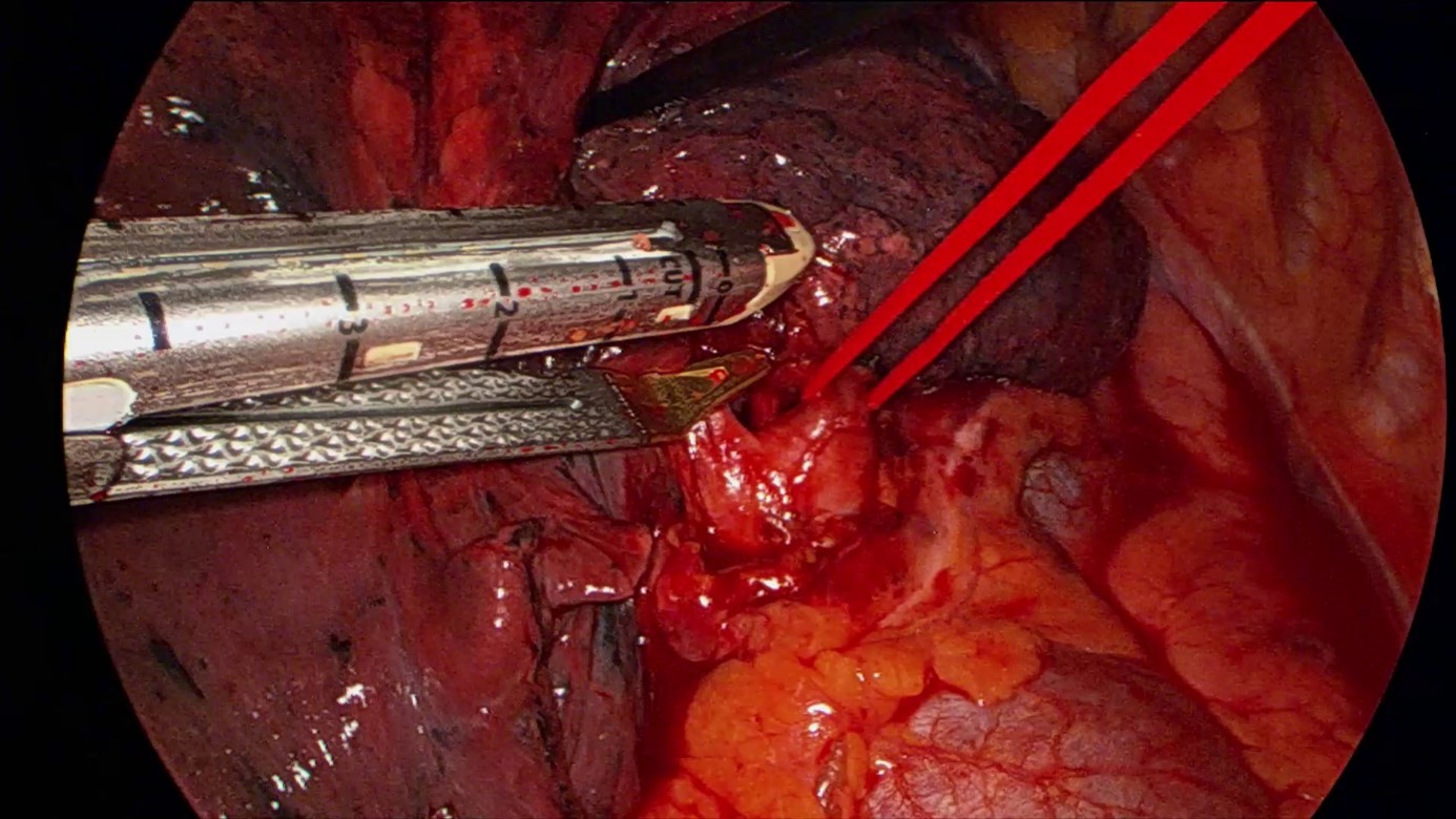 Agrafage de la veine pulmonaire supérieure droite à l’aide d’une agrafeuse électronique lors d’une lobectomie supérieure droite thoracoscopique.