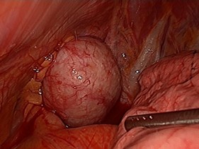 chirurgie thoracique : Volumineux neurinome de 5 cm de diamètre localisé au dôme pleural gauche