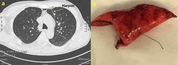 chirurgie thoracique : Repérage pré-opératoire d’un nodule profond lobaire supérieur gauche 