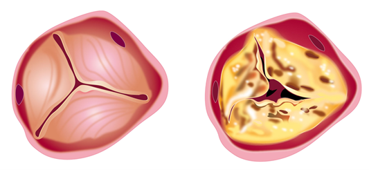 chirurgie-cardiaque : valve aortique normal et valve aortique malade