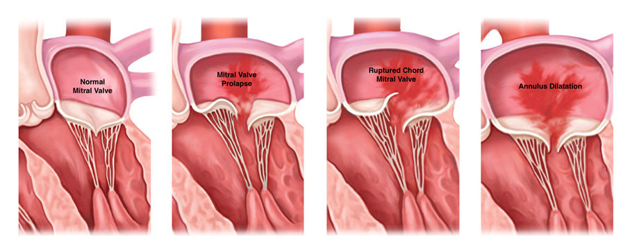 valves mitrales; normale, prolapsus, rupture de la chorde de la valve mitrale, dilatation de l'anneau