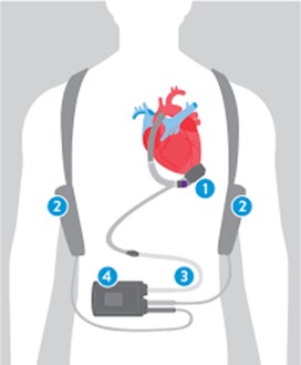 Composants du Système d’assistance ventriculaire gauche