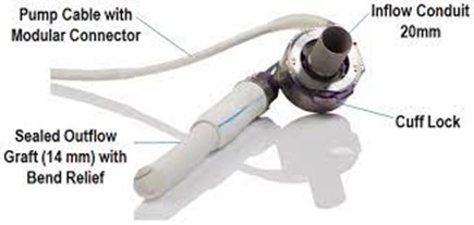 Pompe centrifuge implantée à la pointe du ventricule gauche et raccordée à l’aorte ascendante du patient via une prothèse de 14mm.