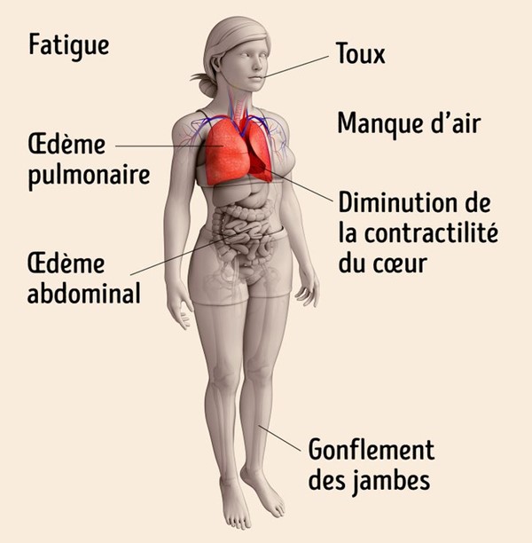 chirurgie-cardiaque - insuffisance cardiaque