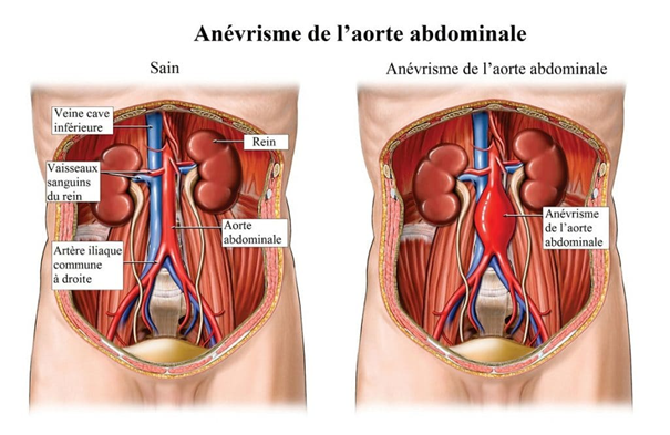 Chirurgie vasculaire : anévrisme de l'aorte abdominale