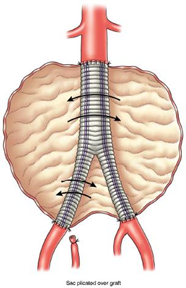 anévrisme aorte abdominale