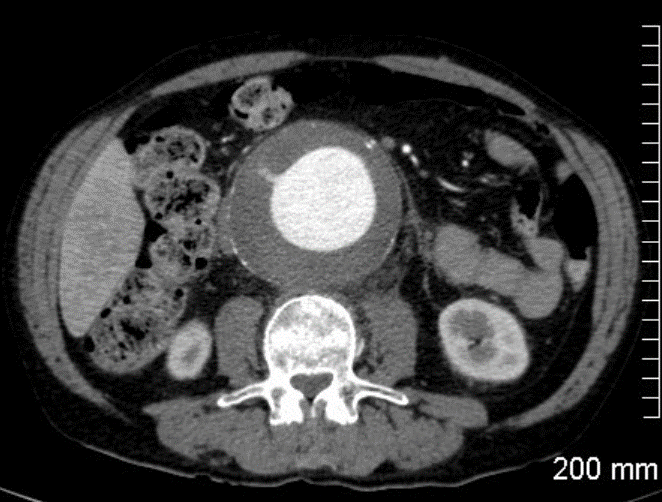 anévrisme de l'aorte