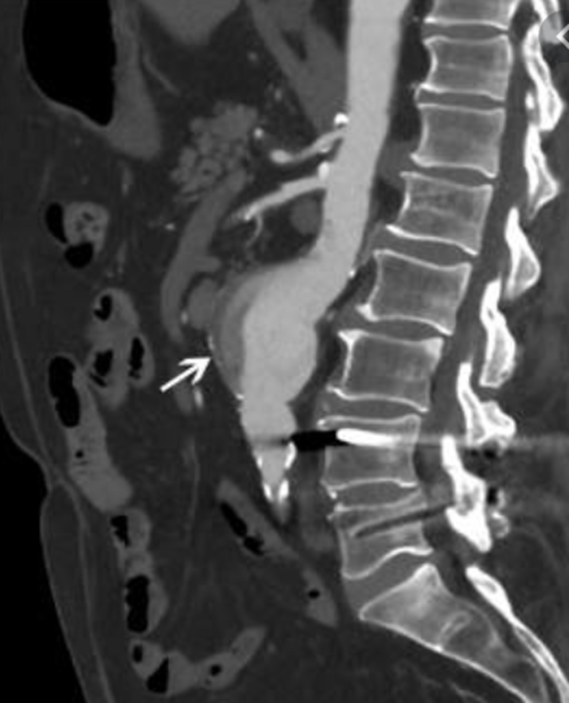 anévrisme de l'aorte