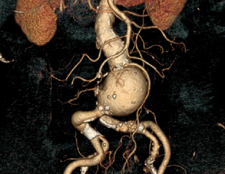 anévrisme de l'aorte