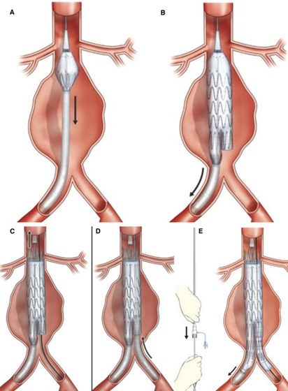 chirurgie vasculaire : réparation des anévrismes aortiques abdominales par traitement endovasculaire; endoprthèse