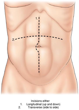 chirurgie vasculaire : incisions